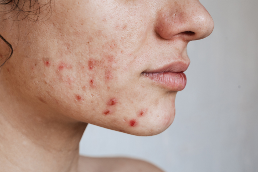 Why Moisturising is Key for Acne-Prone Skin